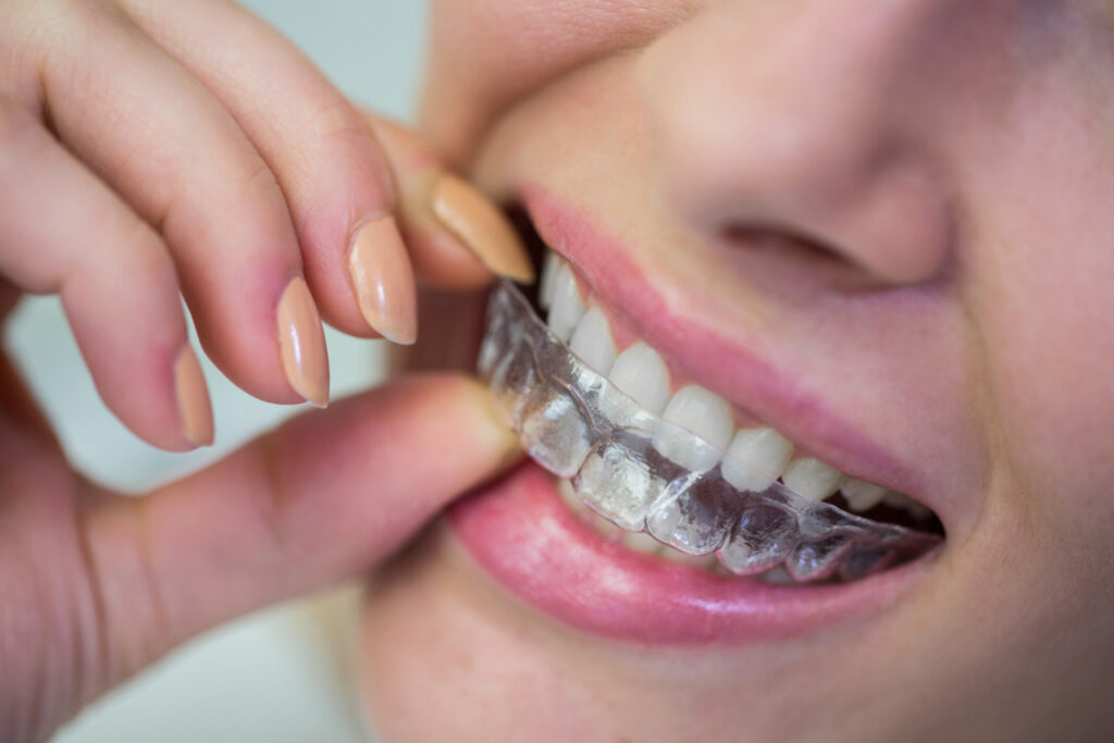 Clear Aligners for teeth